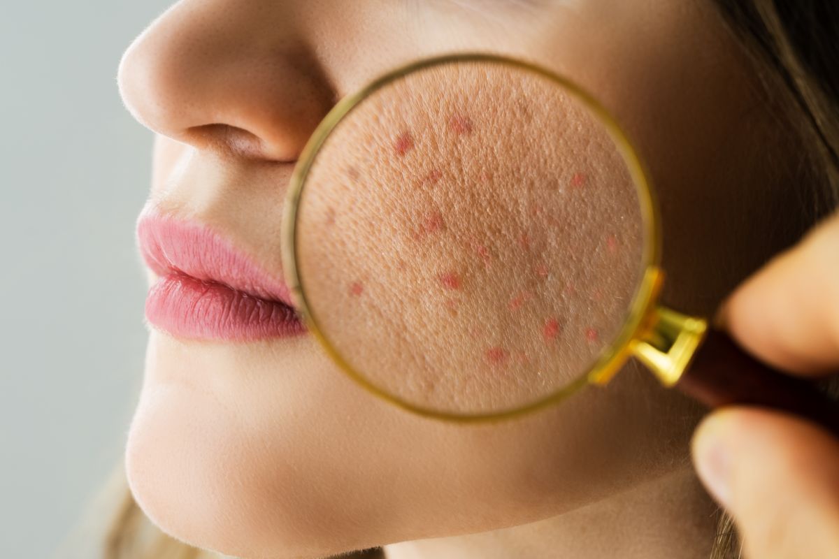 como prevenir a acne